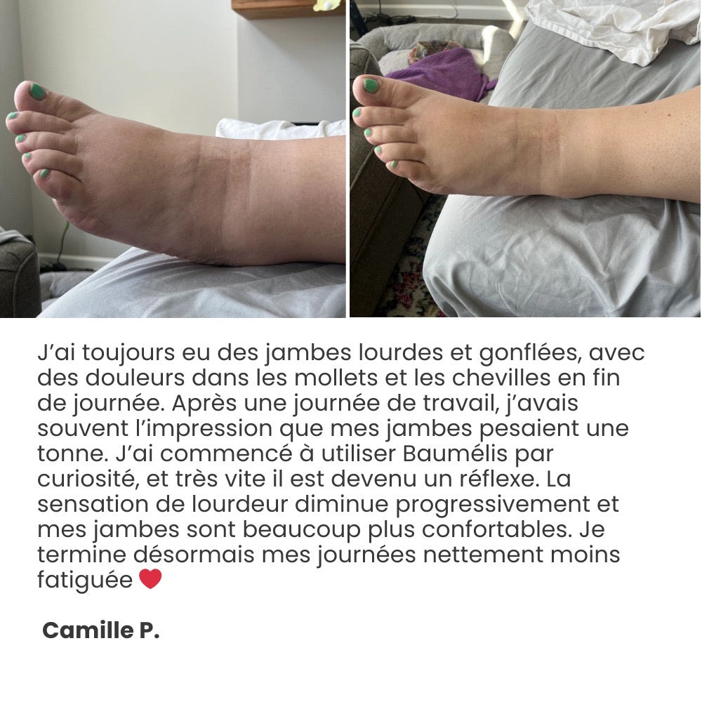Témoignage cliente Camille P. — photos comparatives du pied et de la cheville, ressenti de confort au quotidien.