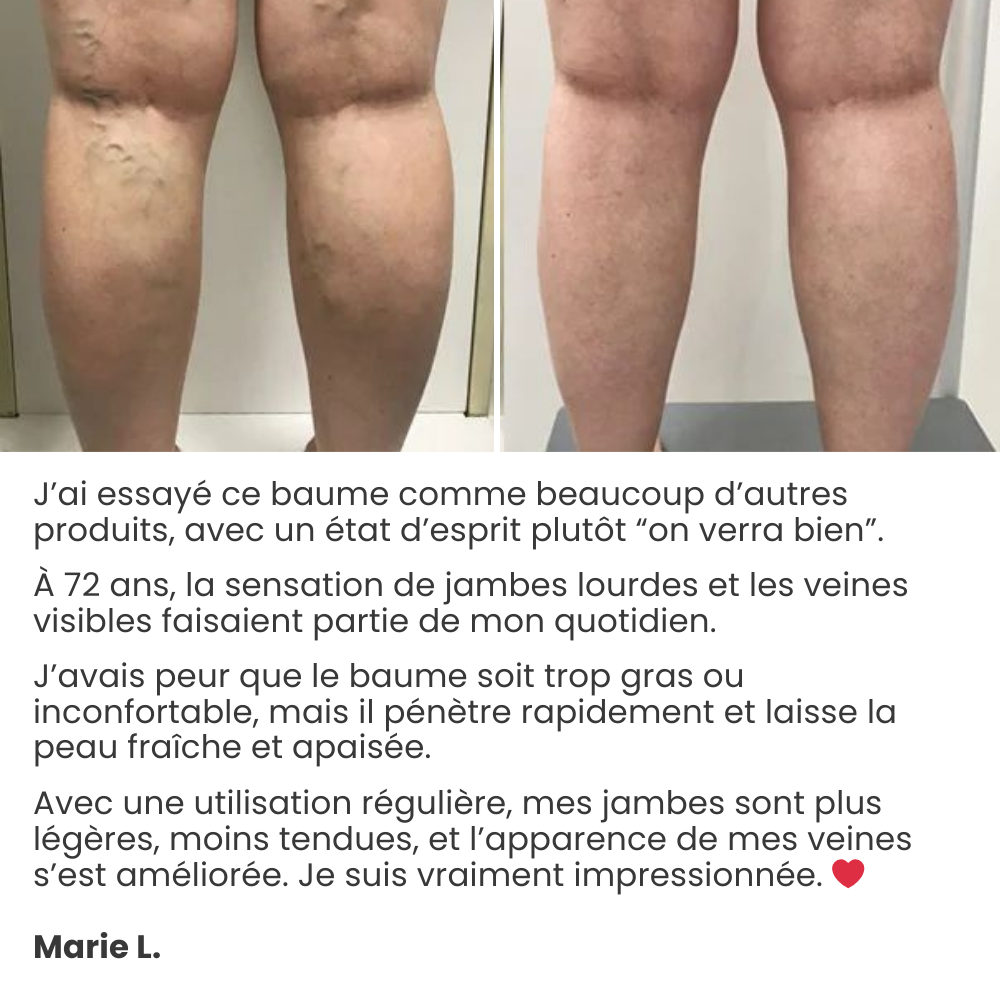 Témoignage cliente Marie L. — photos comparatives des jambes avant/après.